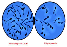 oligozoospermia